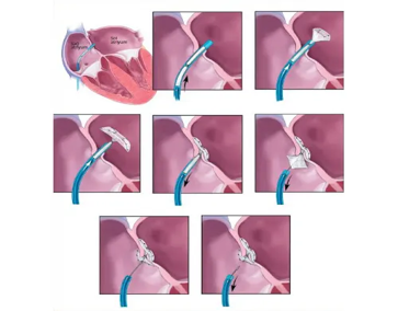 Kalp deliklerinin ameliyatsız kapatılması (ASD, VSD, PFO, PDA)